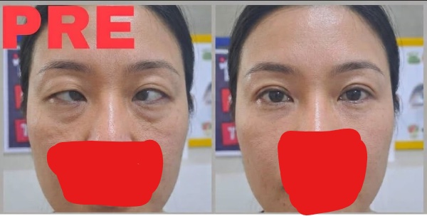 Before and after: adult patient's eye-turn corrected with vision therapy