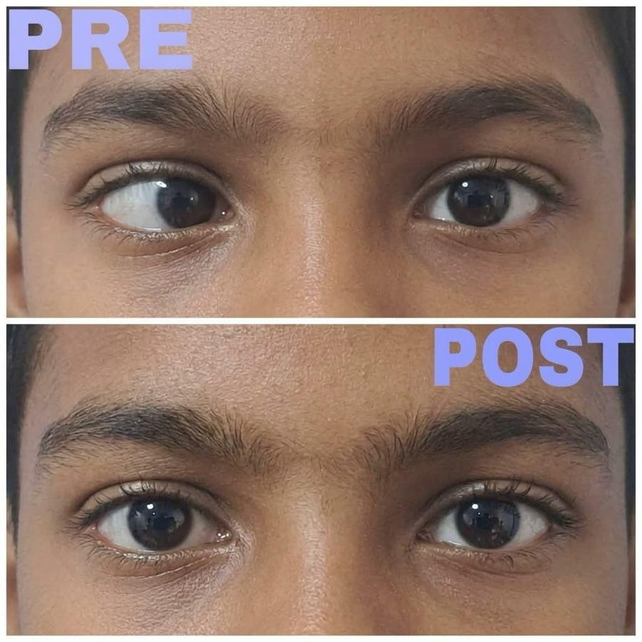 Child's eyes before and after orthoptic vision therapy: an outward eye-turn corrected to straight alignment